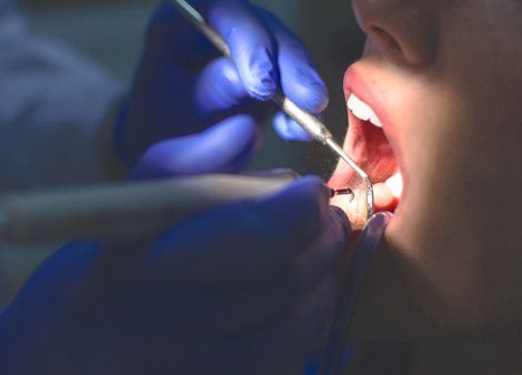 Tooth Extraction — Stone Removal Procedure in Lafayette, IN