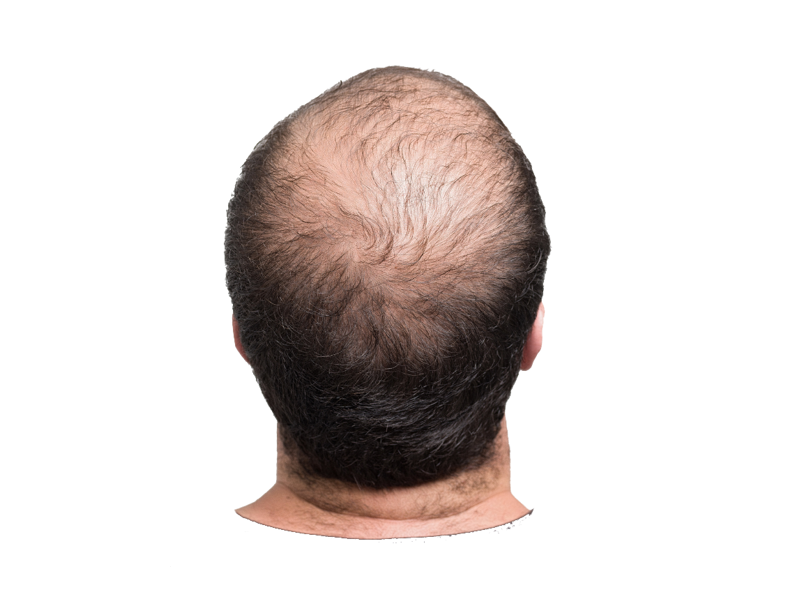 The back of a man 's head with a bald spot on it.