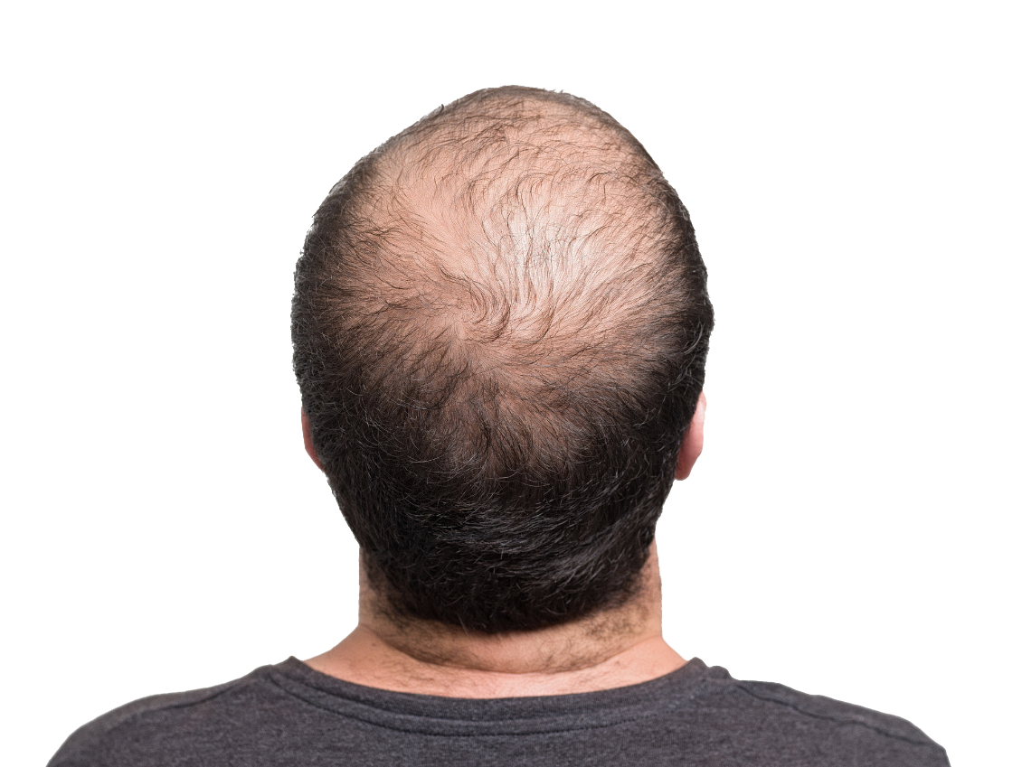 The back of a man 's head with a bald spot on it.