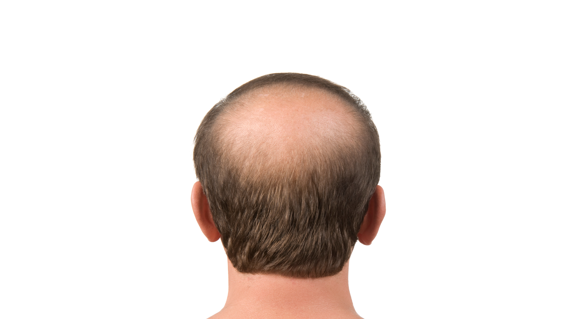 The back of a man 's head with a bald spot.