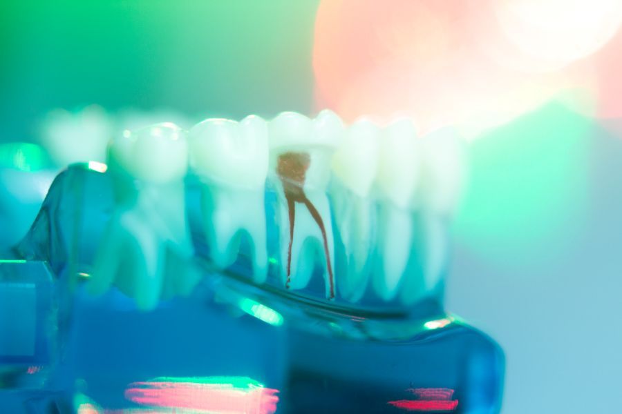 trattamenti di endodonzia