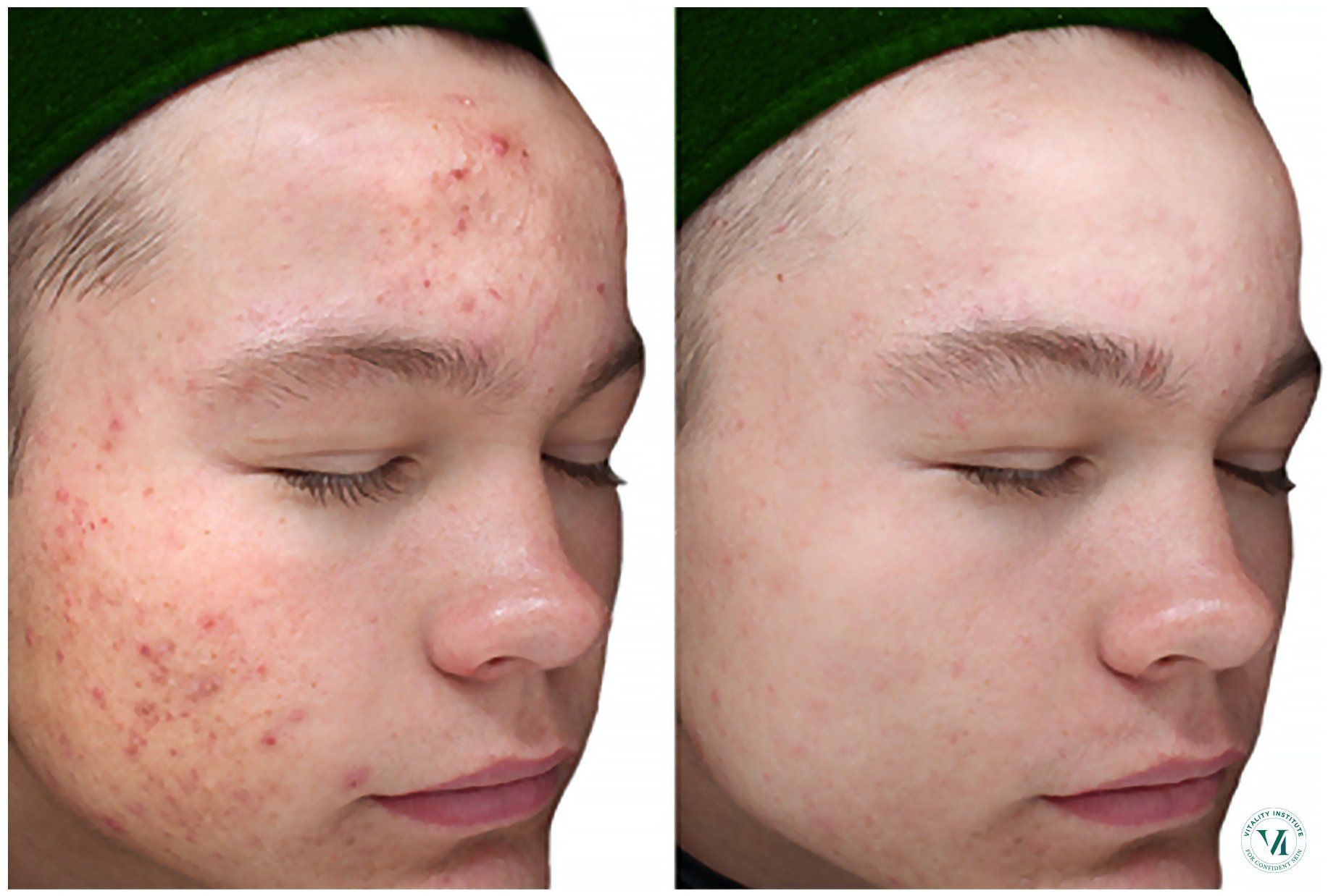 Woman With Acnes On Her Face — Casper, WY — SkinCare By Vondi