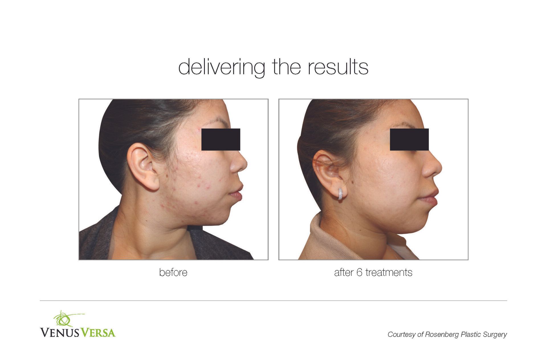 Before And After Photo Of Viva Radio Frequency — Casper, WY — SkinCare By Vondi