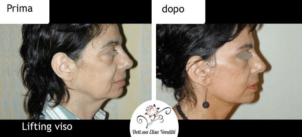 Lifting viso prima e dopo