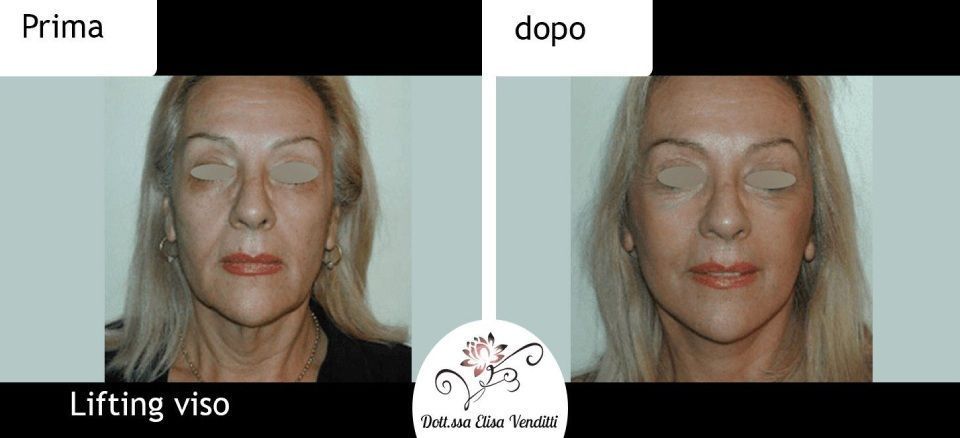 Lifting prima e dopo