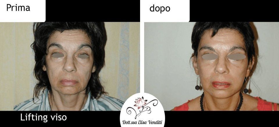 Trattamento lifting prima e dopo