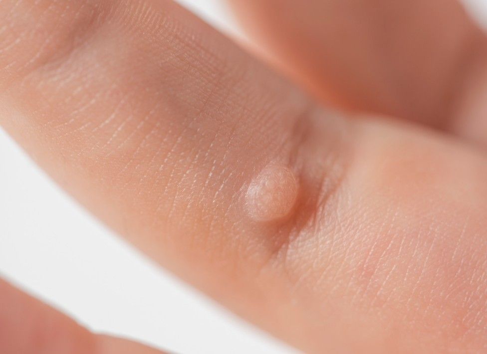 wart on the inside of a client's finger in Coventry