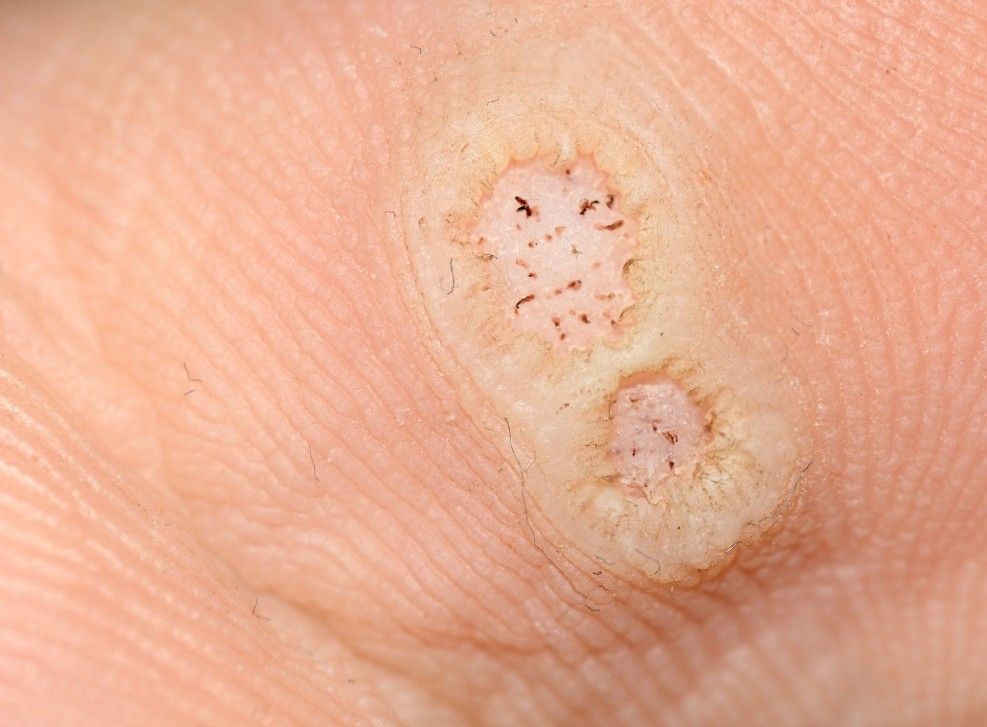 The Skinutrition Clinic before performing a skin tag removal in Coventry