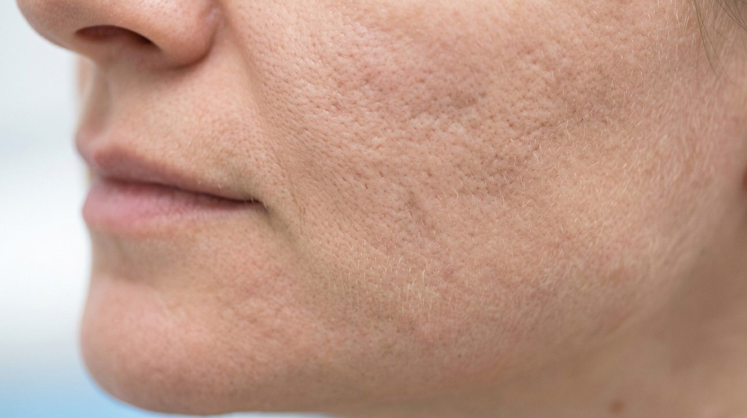 Close-up of skin showing subtle but visible acne scarring and textural irregularity on a cheek in Skinutrition's Coventry clinic