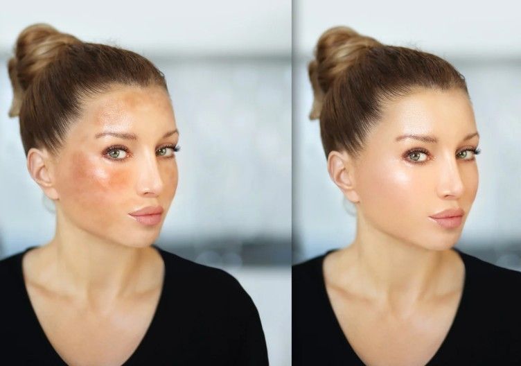 before and after images of a chemical peel treatment for a client with hyperpigmentation