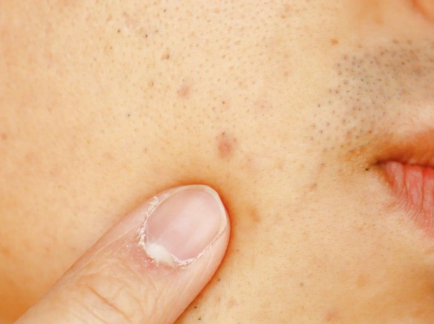 client with brown spots to be removed