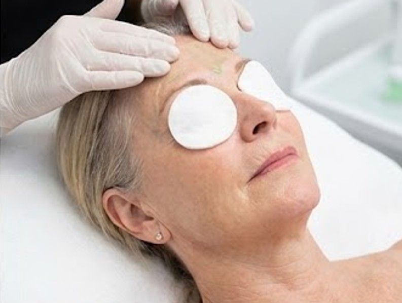 BioRePeel solution on a client's face in Coventry