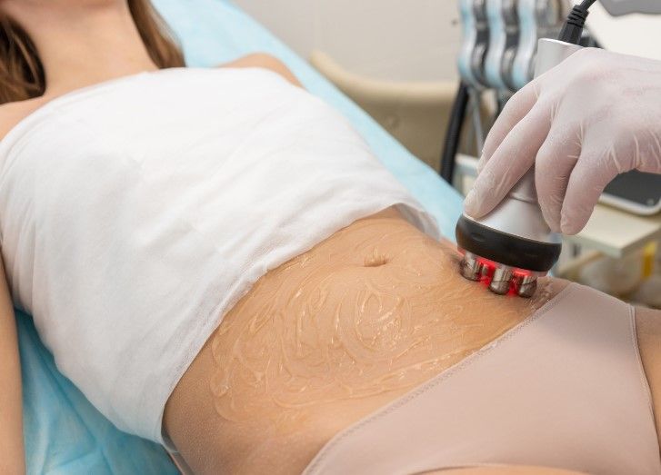 Skinutrition performing plasma skin tightening at their clinic in Coventry