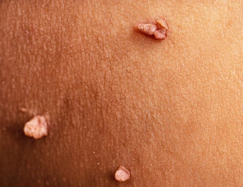 The Skinutrition Clinic about to remove skin tags for a client