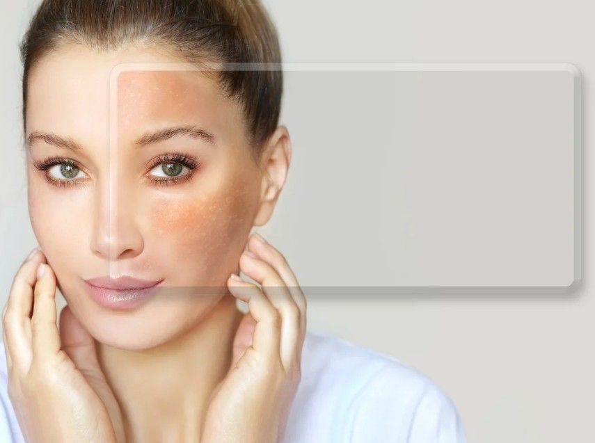 Client who has had their before treatment shown over post-chemical peel treatment for pigmentation issues