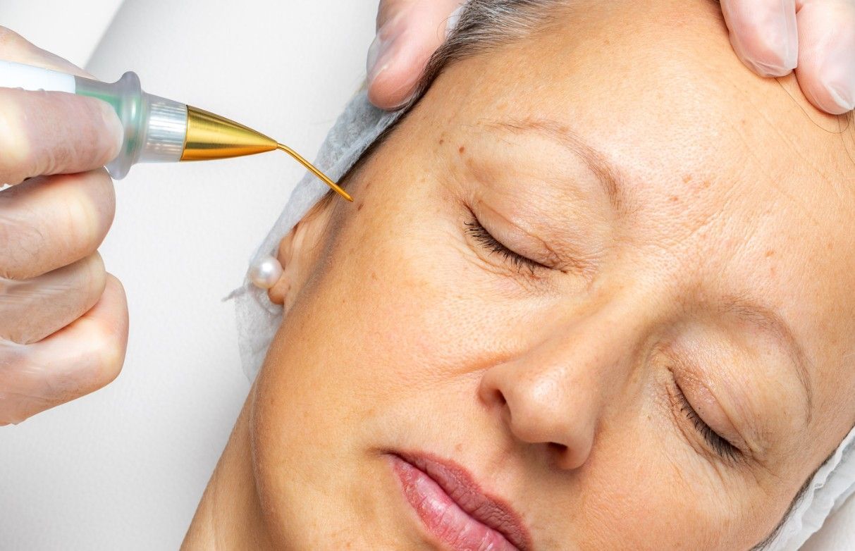 Client having a facial wart removed using a plasma pen