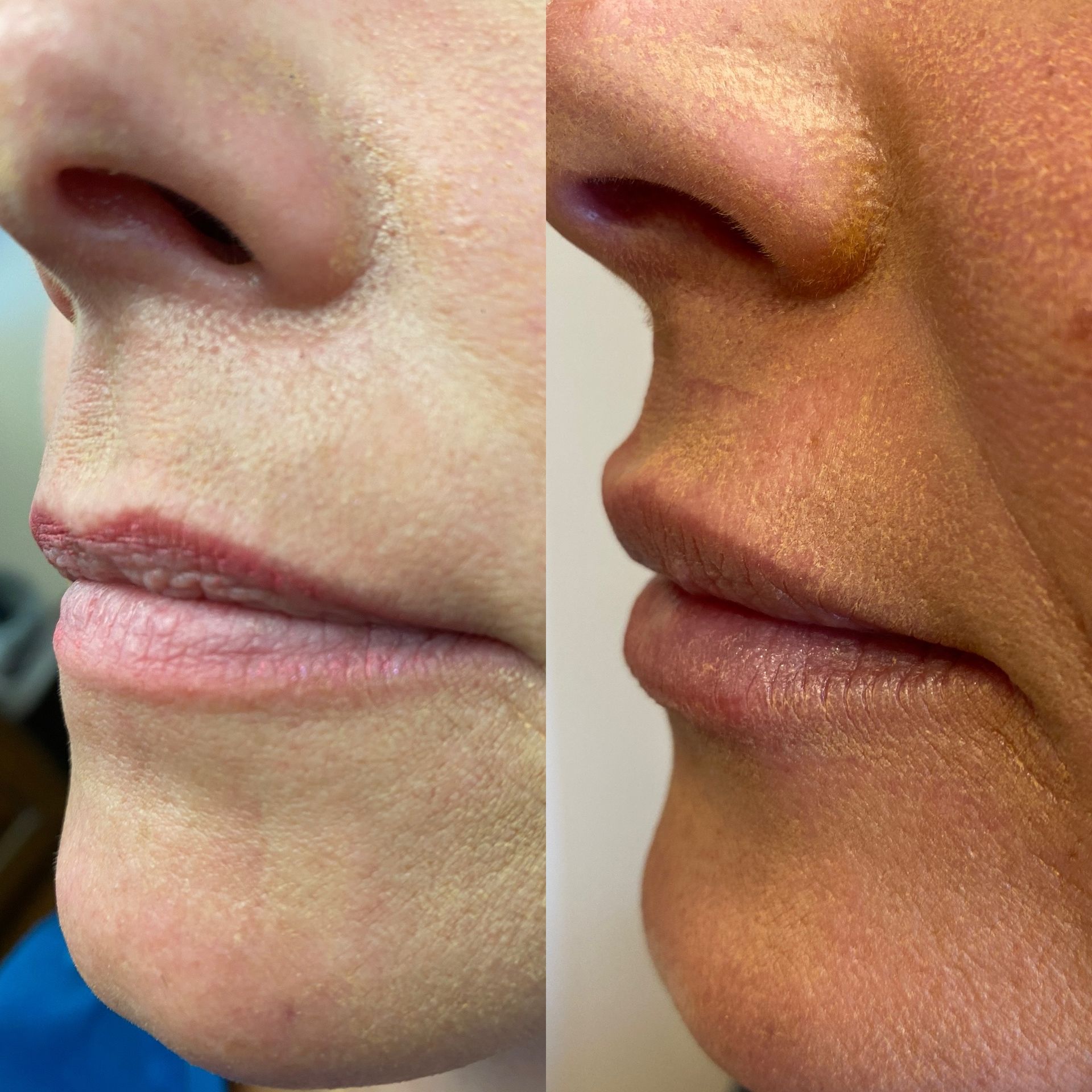 Lip filler Revanesse Versa+