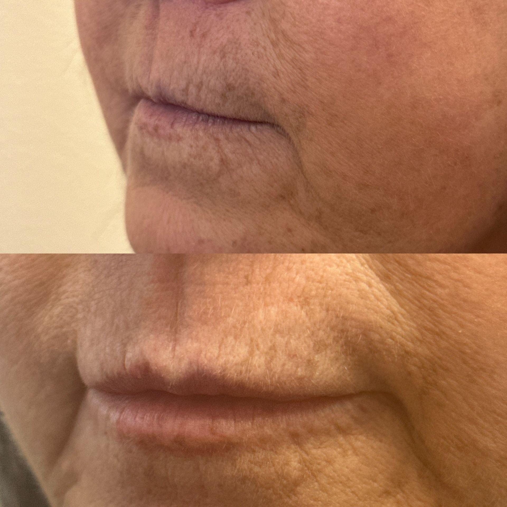Lip filler - restore lost volume and shape