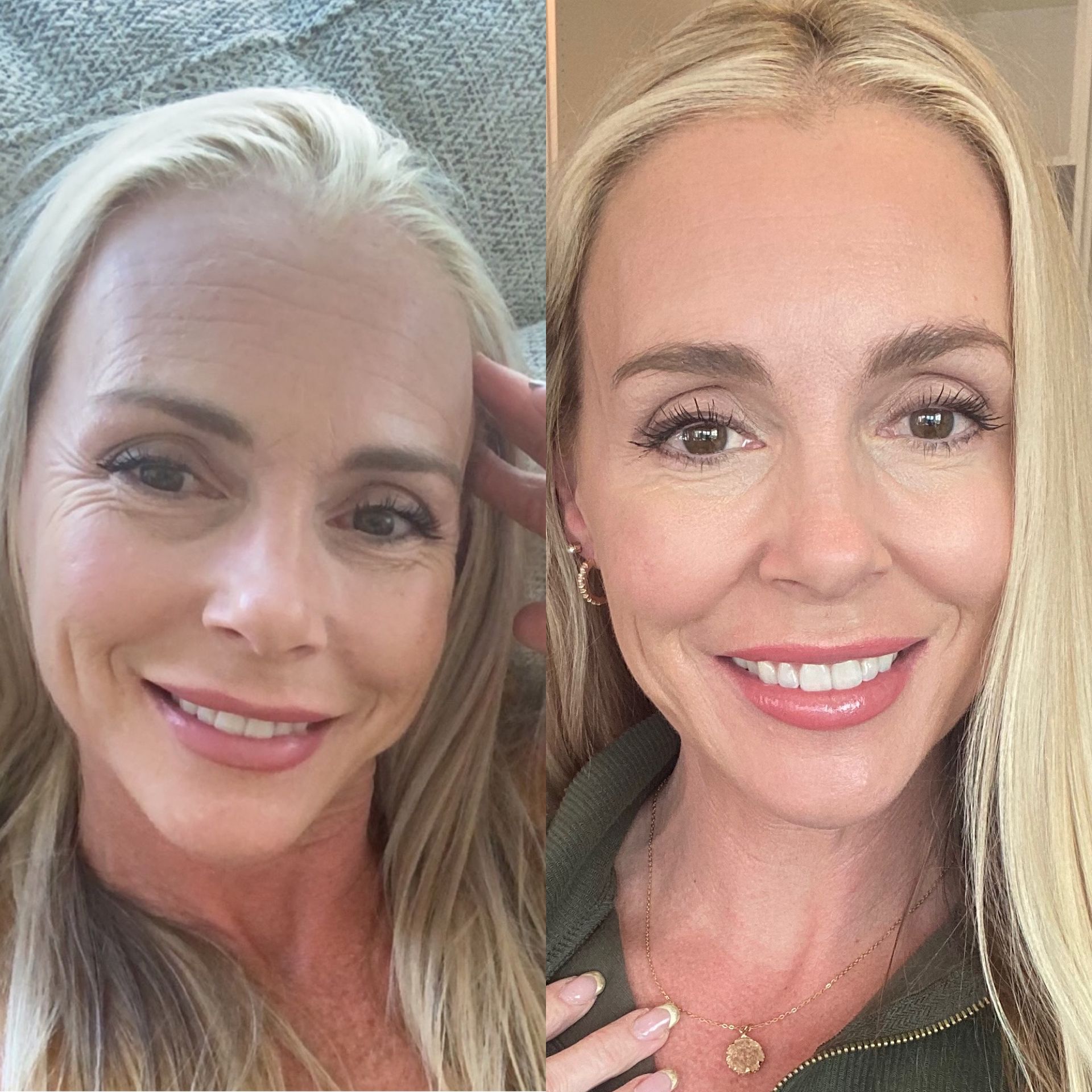 Botox forehead/ crow’s feet