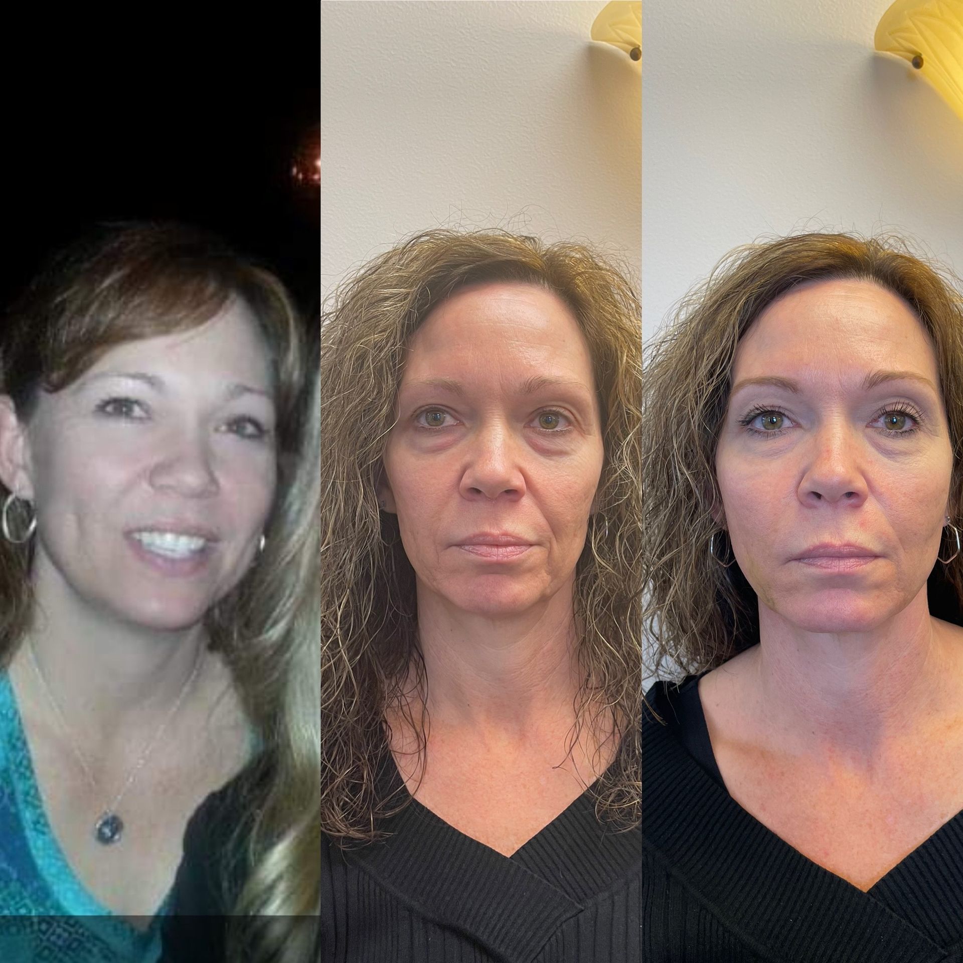 Threadlift