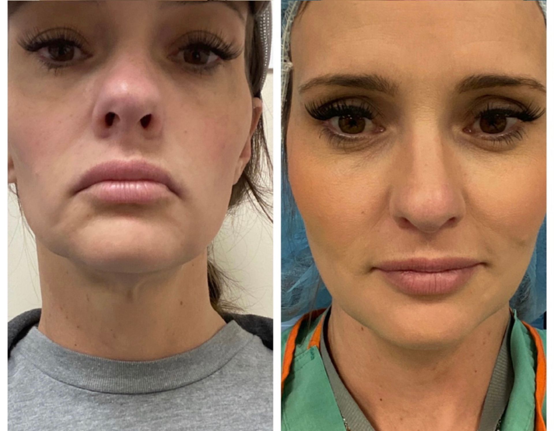 Threadlift midface