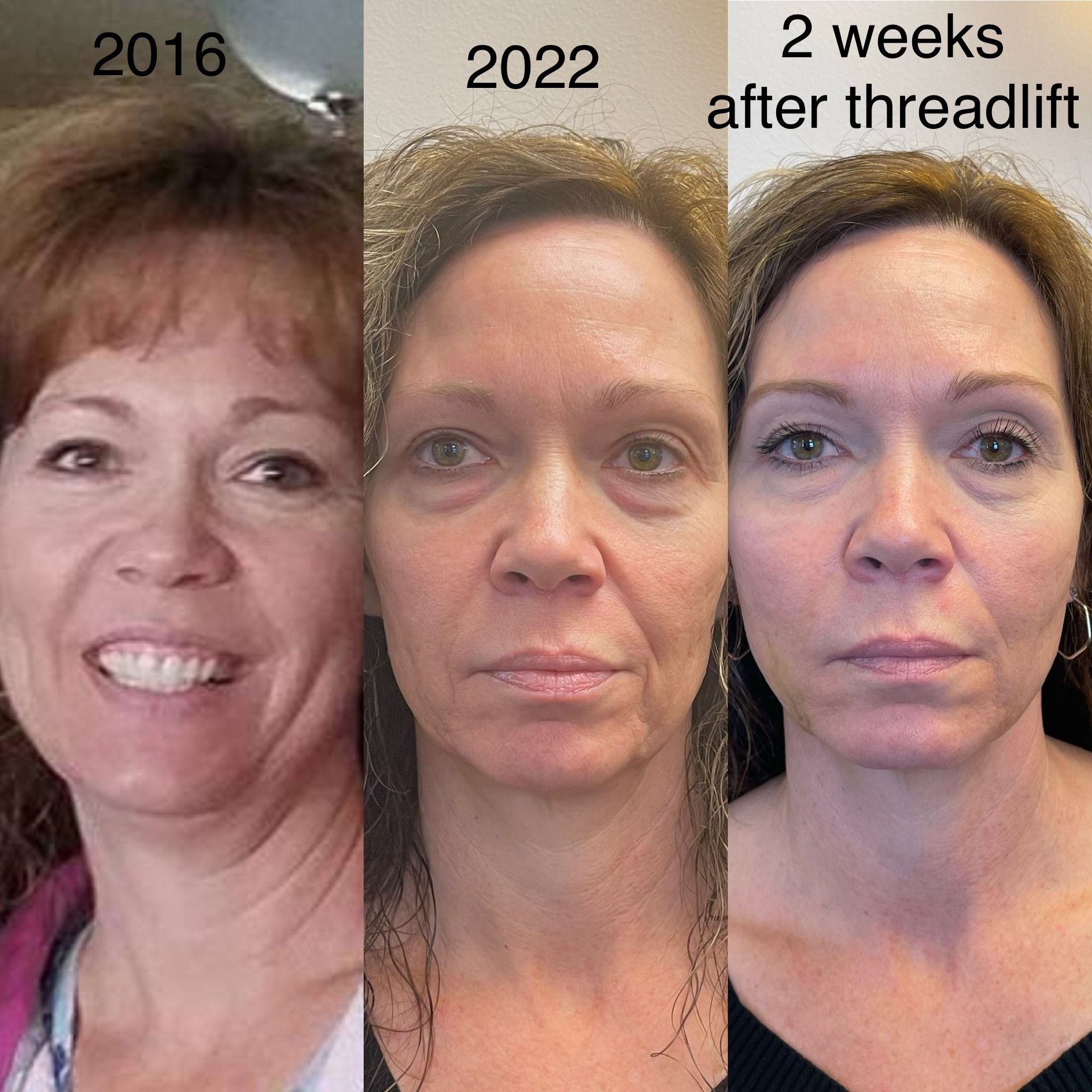 Threadlift