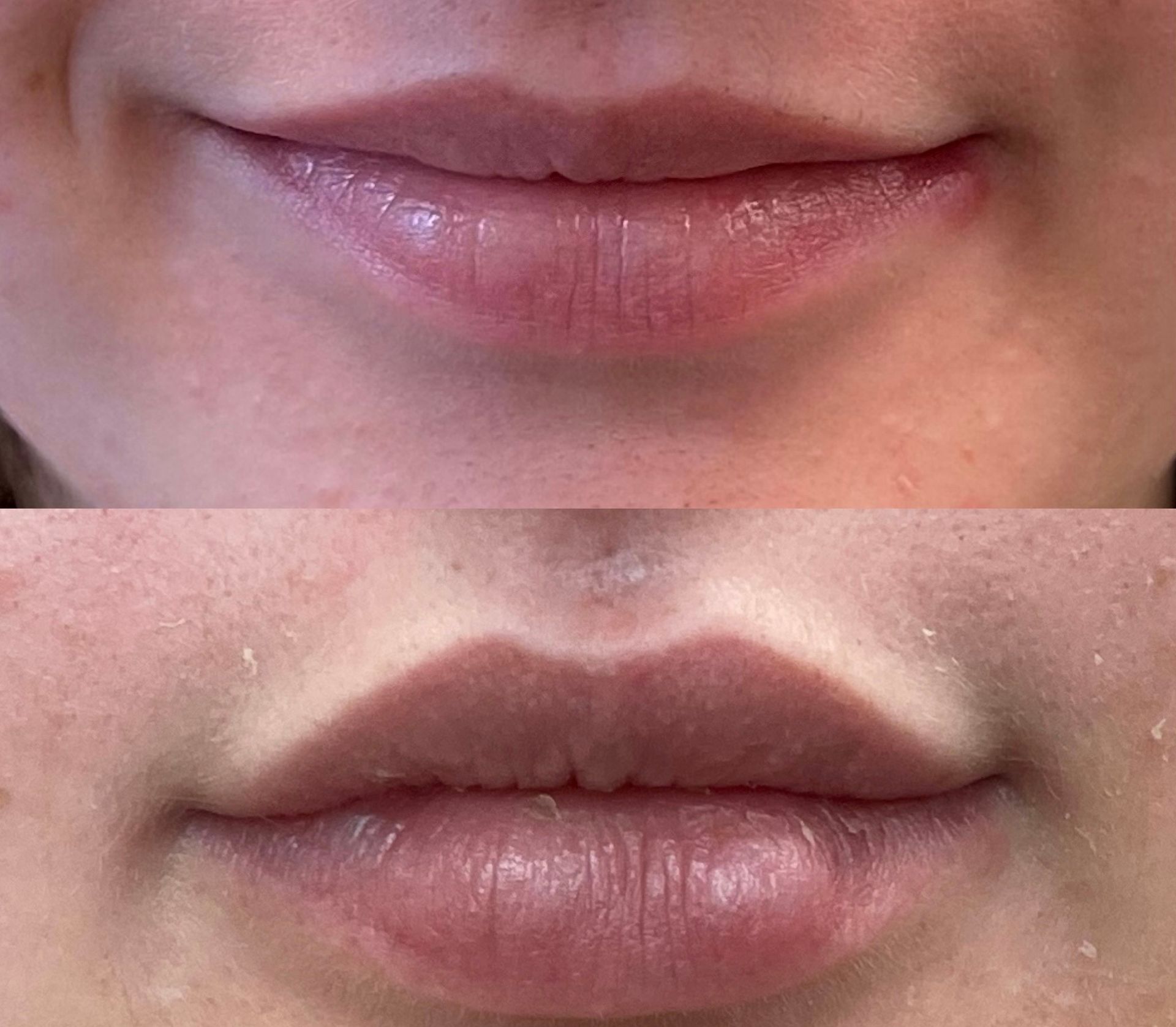 Lip enhancement - filler