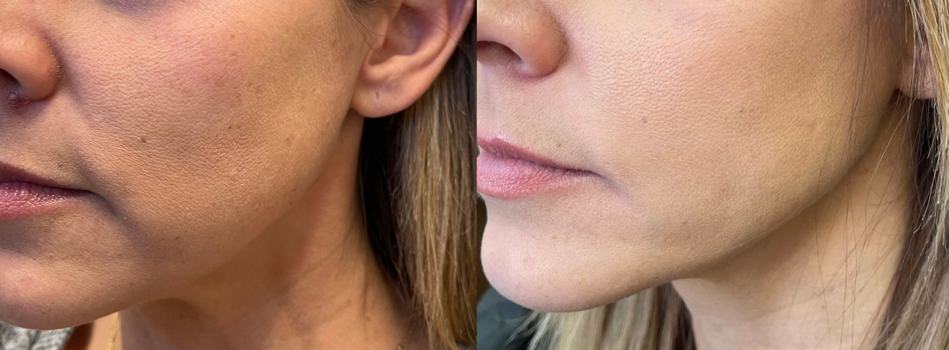 Threadlift - marionette lines