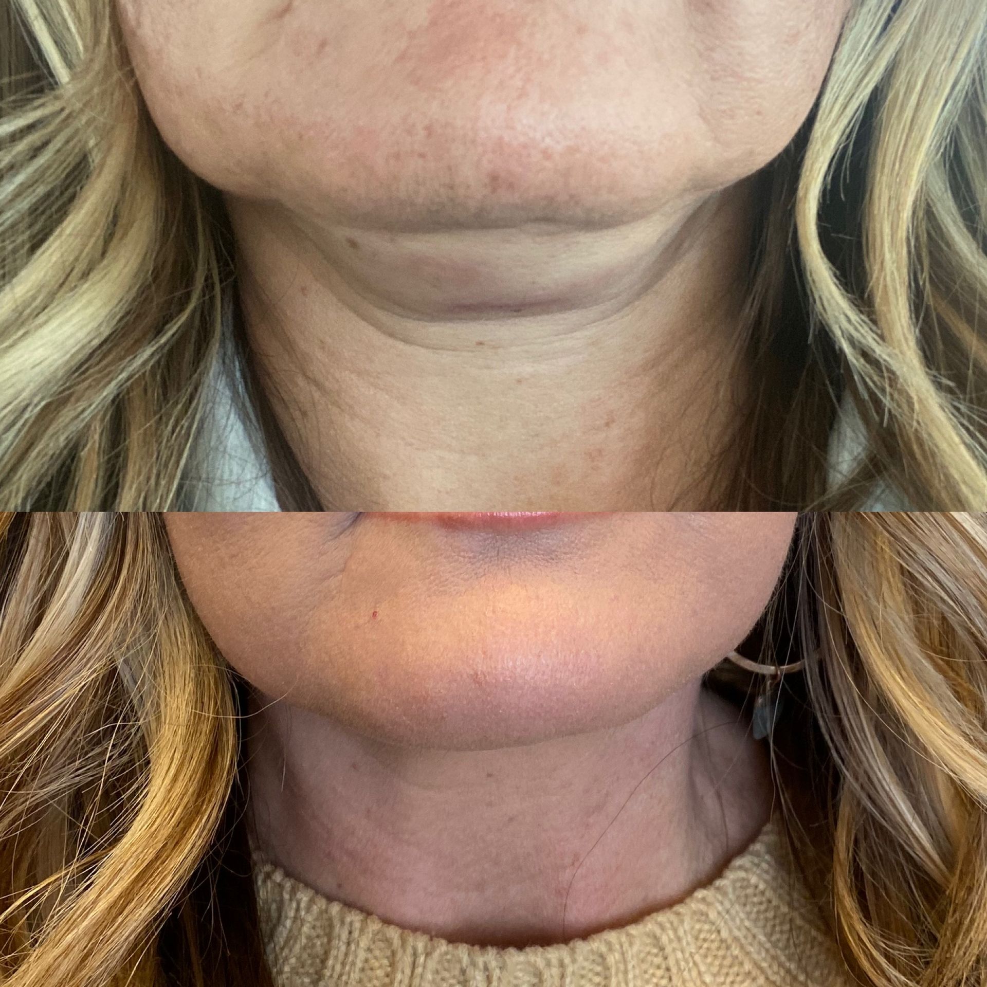 RF (radiofrequency) treatment series