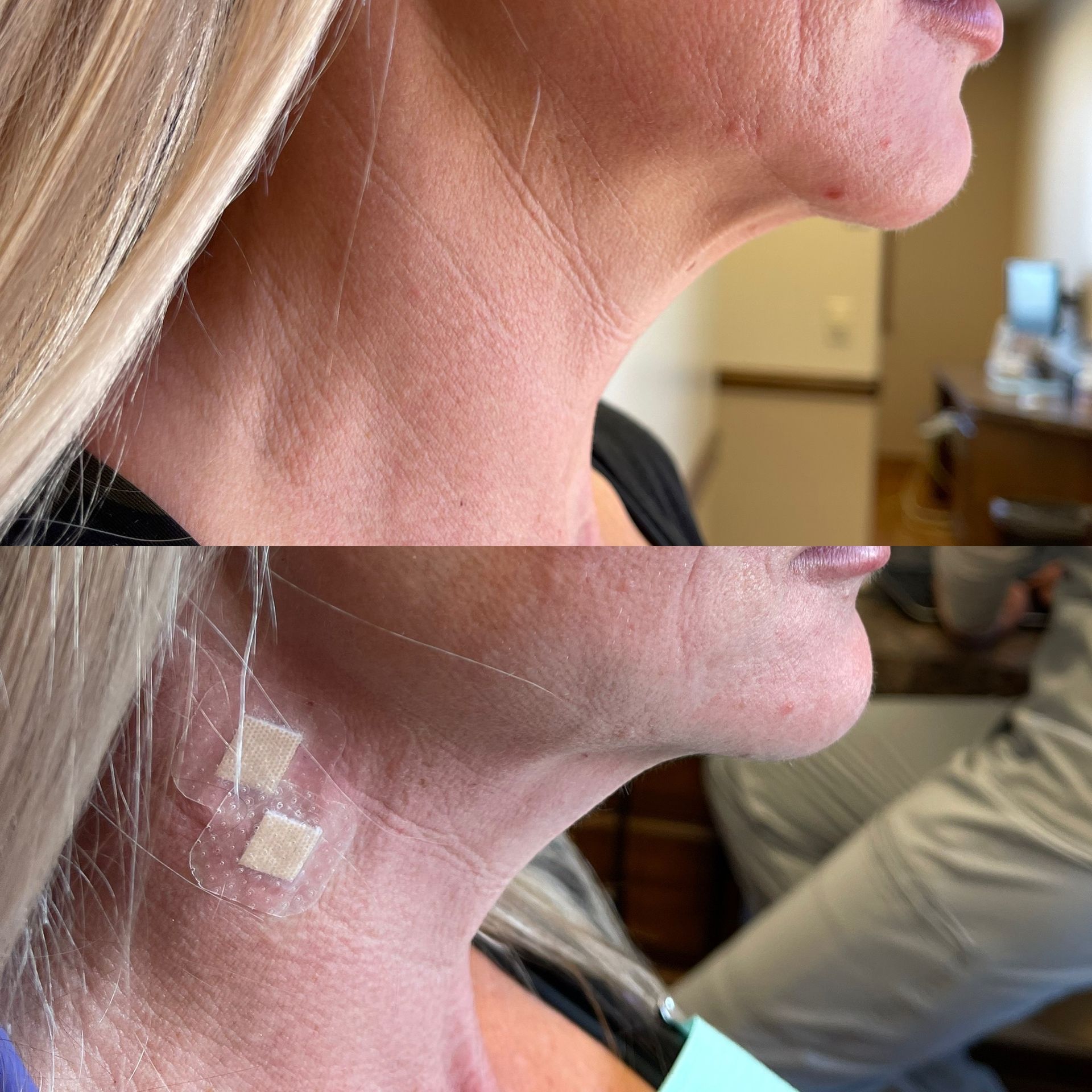 Neck Threadlift 