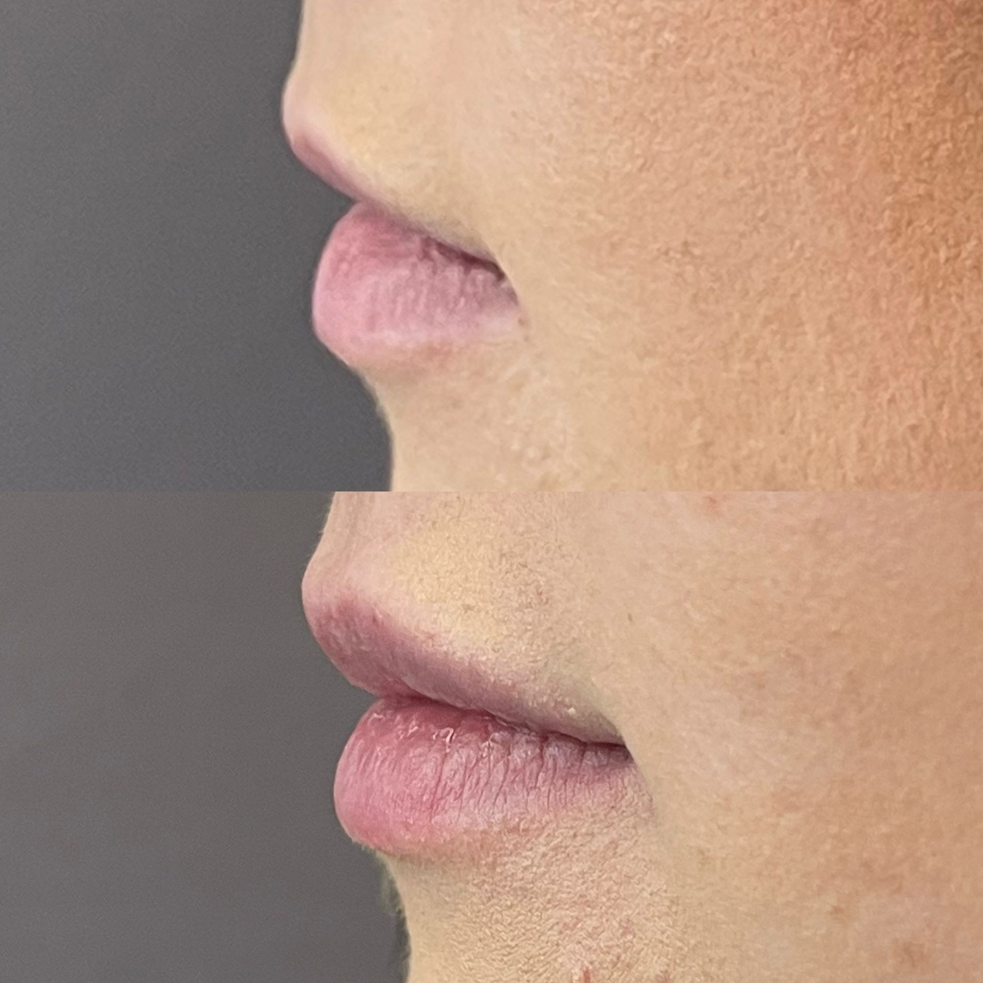 Lip filler