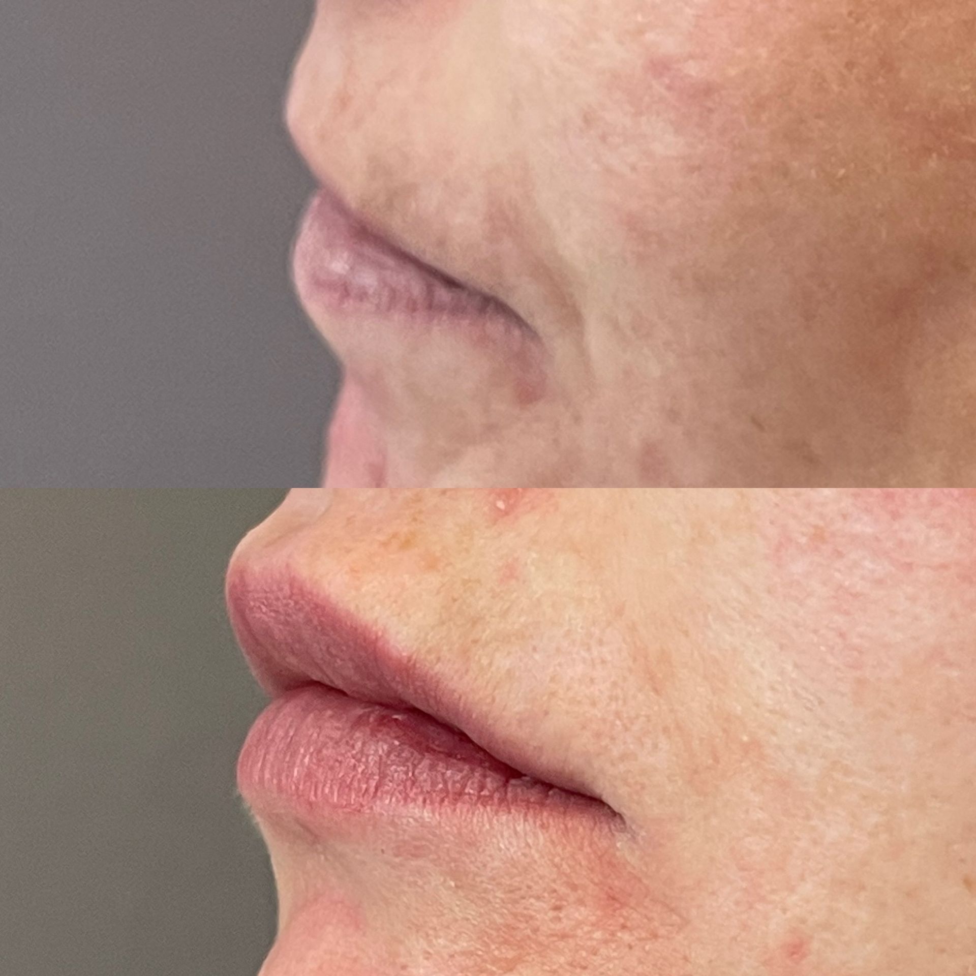Lip filler- volume and projection
