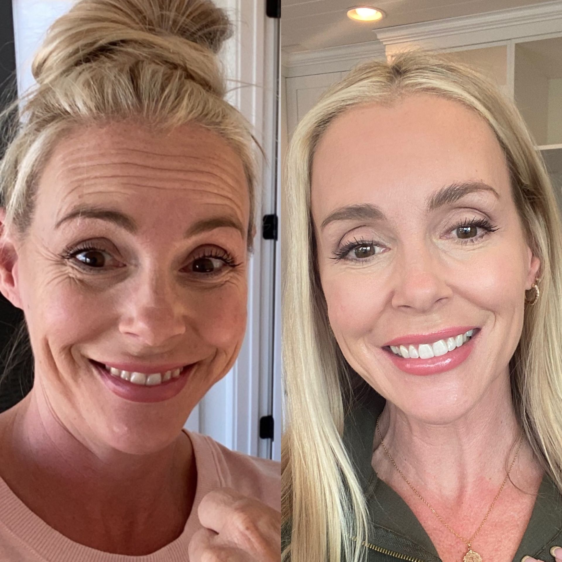 Botox forehead/ crow’s feet