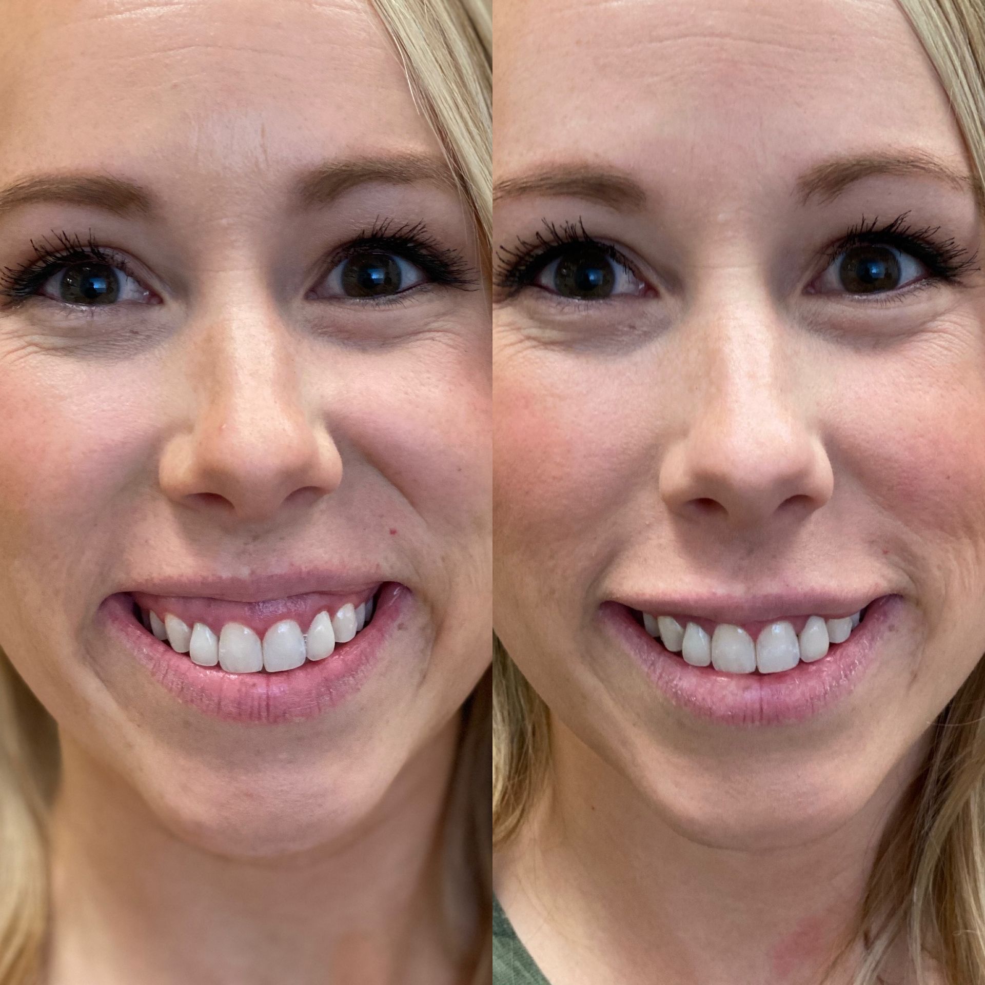 Lip filler / Botox