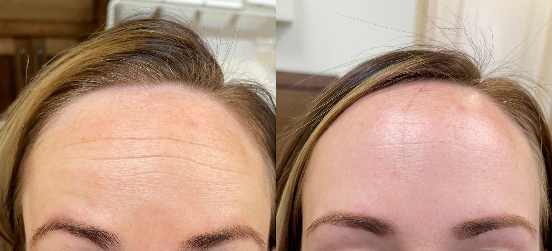 Botox (forehead)
