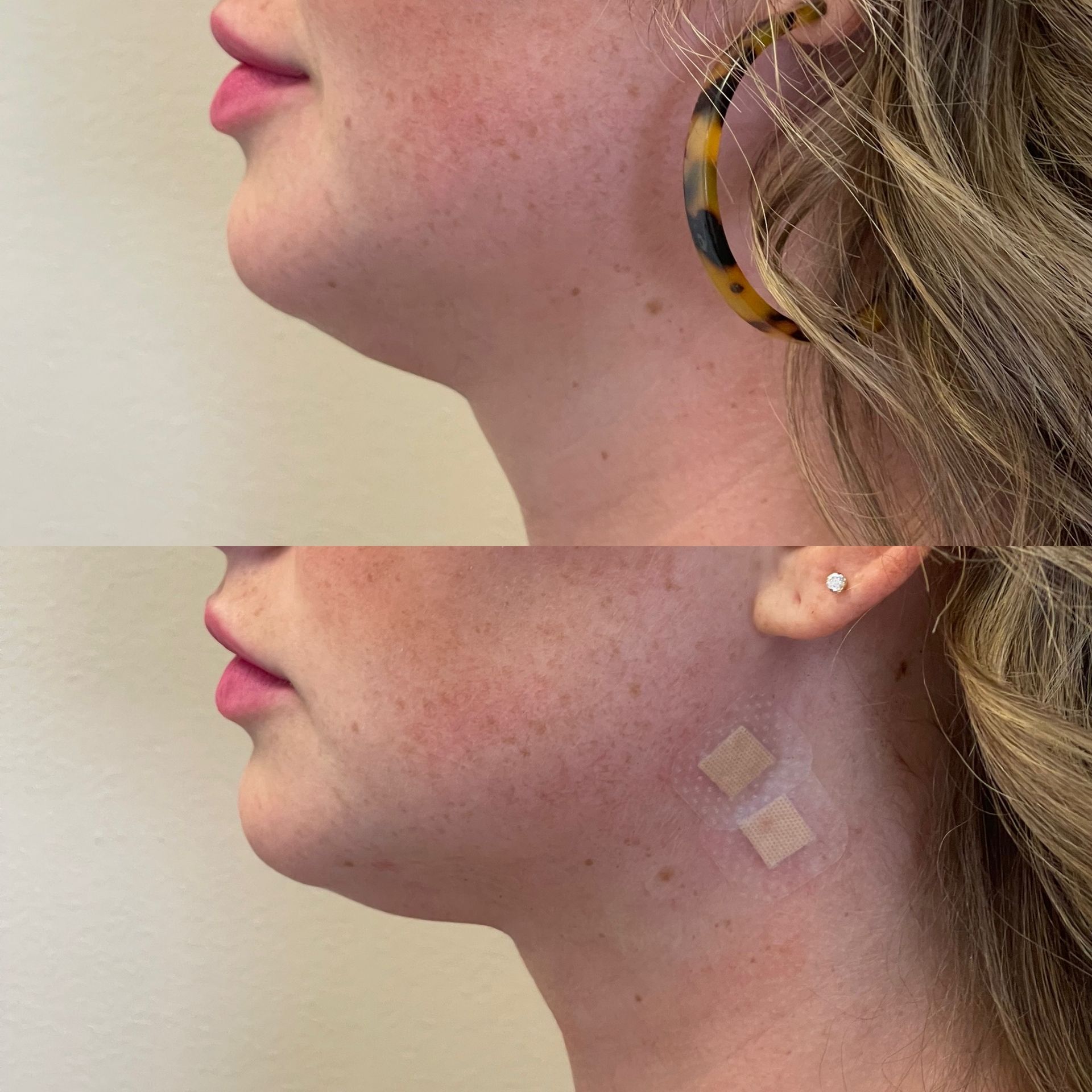 Threadlift - neck/chin