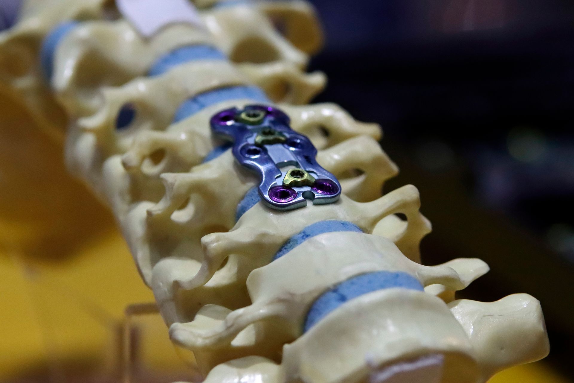 A spine implant.