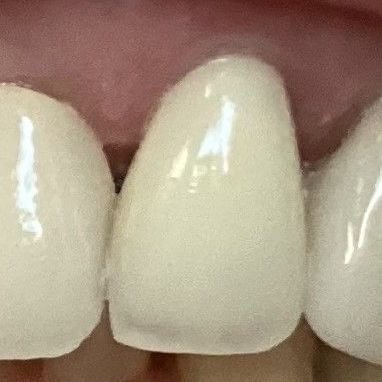 Before and After