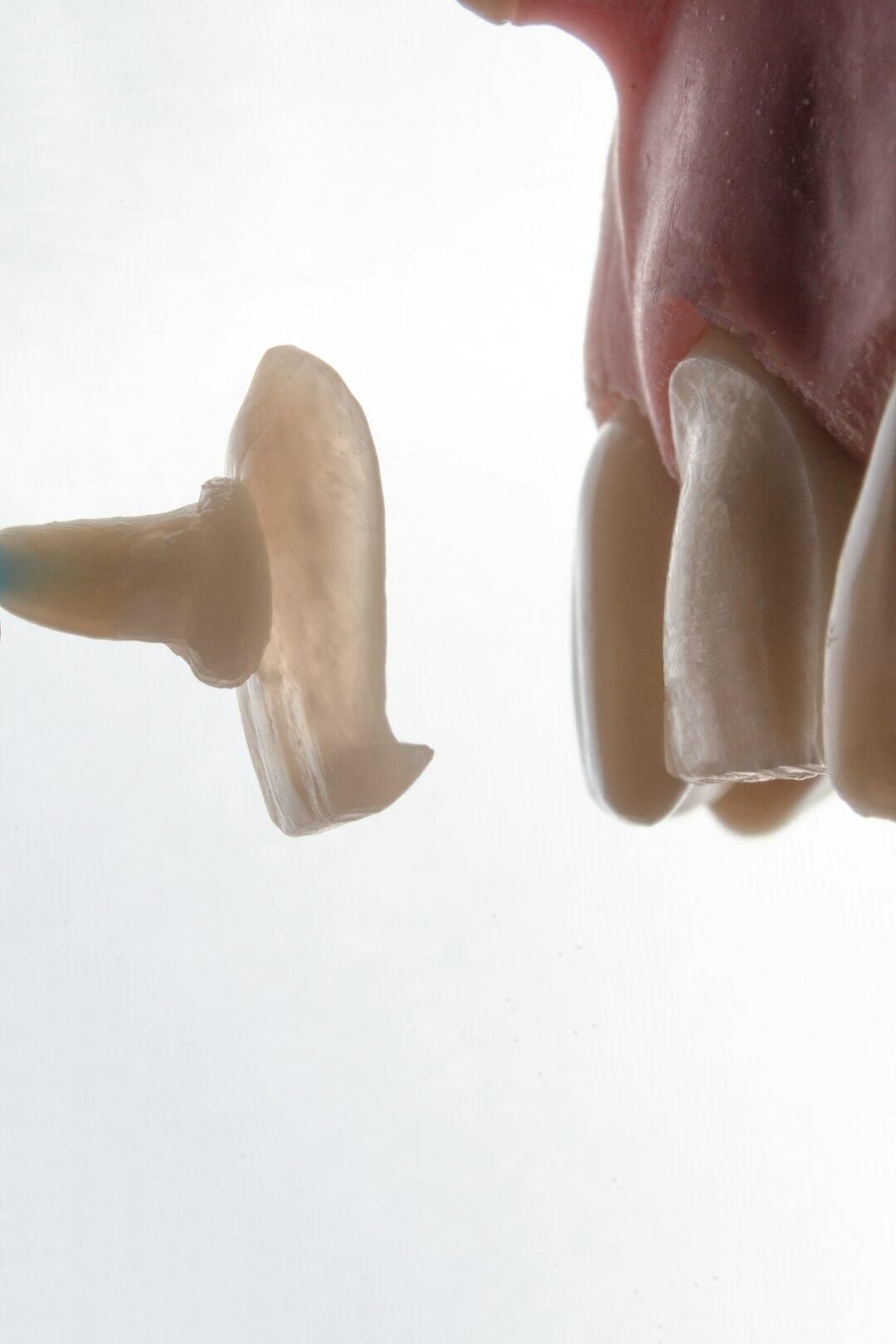 A detached dental veneer next to teeth; a dental procedure against a white backdrop.