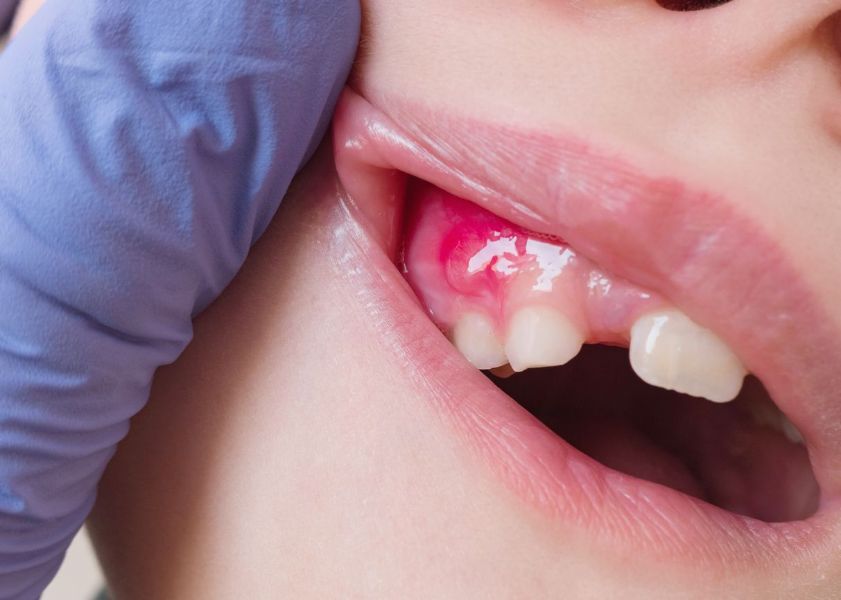 A close up of a child 's teeth with a toothache.