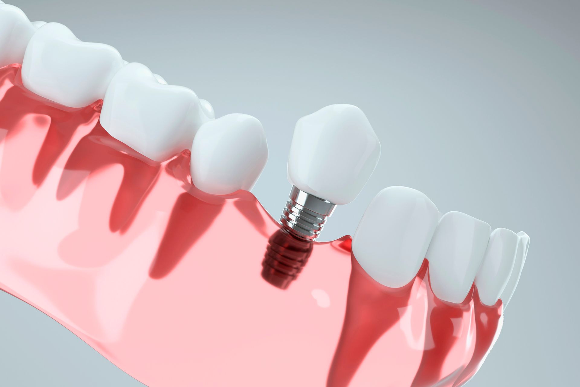 A model of a tooth with a dental implant in it.
