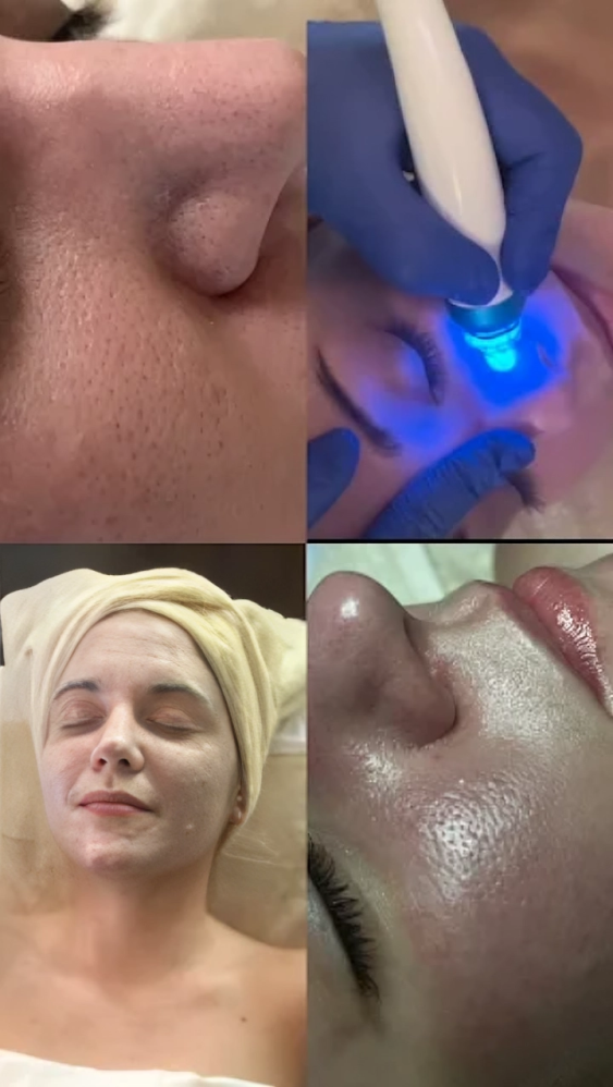 A woman is getting a laser treatment on her face.