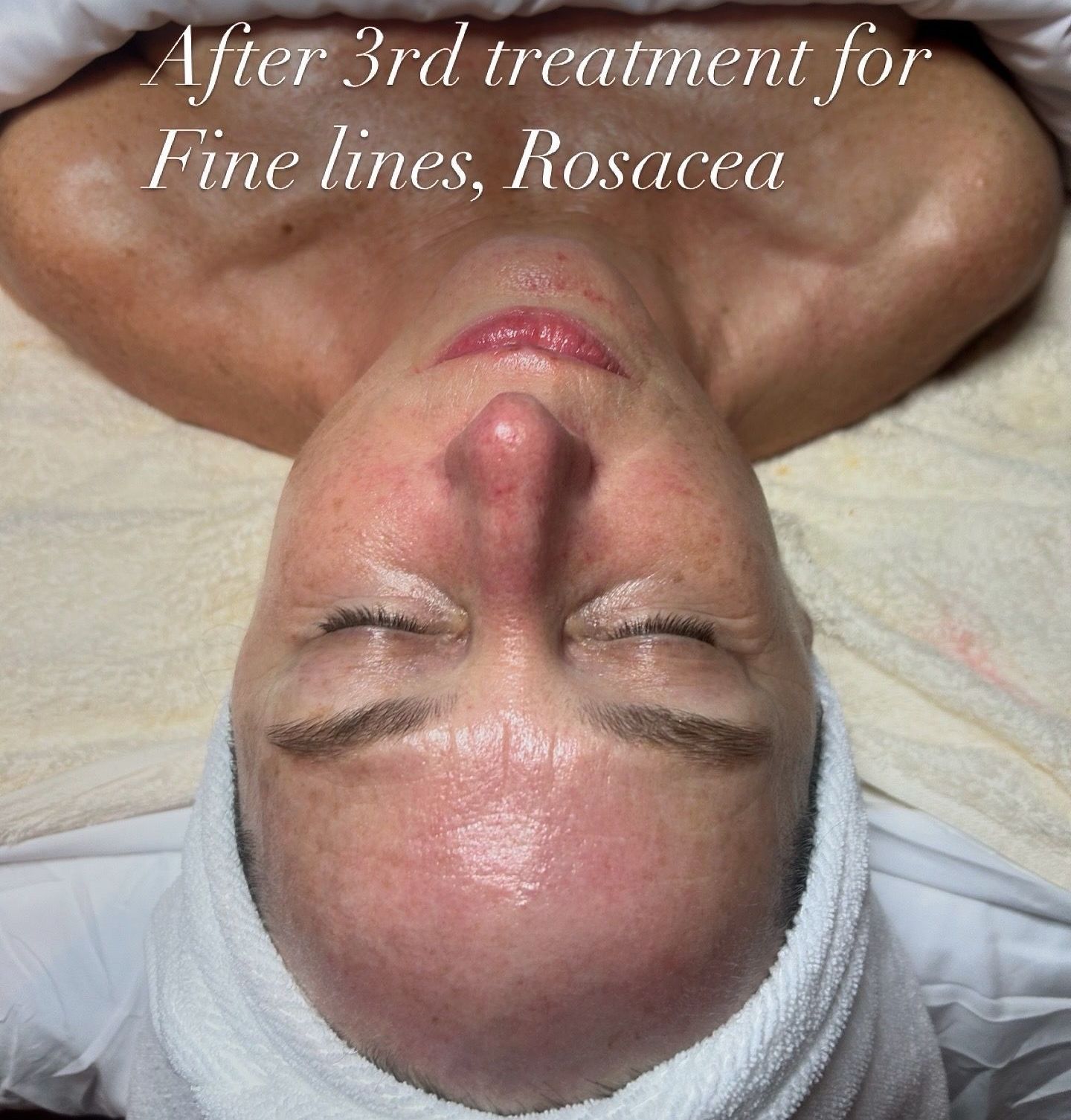 A woman laying on her back with her eyes closed and the words after 3rd treatment for fine lines rosacea