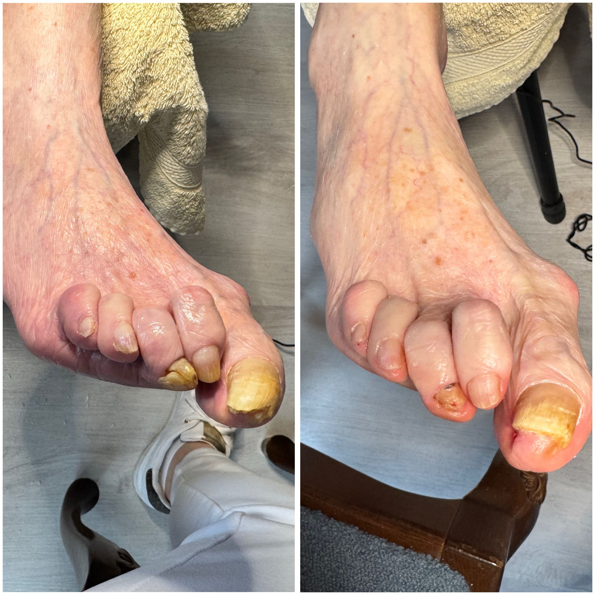 Ein Vorher-Nachher-Foto der Füße einer Person.