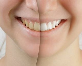 Teeth Whitening — Smile Before and After Teeth Whitening in Brownsburg, IN