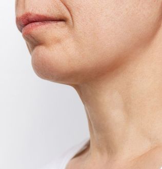 iinSkin Clinic Windsor; After Non-Surgical Facelift Treatment