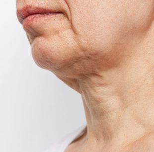 iinSkin Clinic Windsor; Before Non-Surgical Facelift Treatment