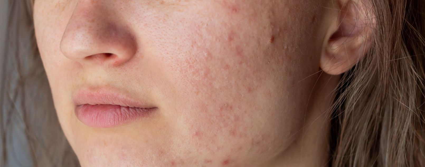 A close up of a woman 's face with acne on it.