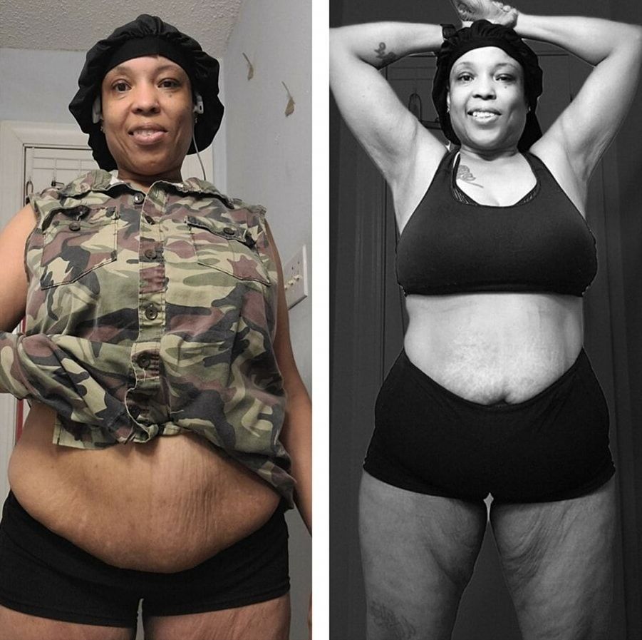 A black and white photo of a woman 's stomach before and after losing weight.