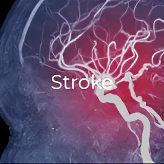 An x-ray of a person 's brain showing a stroke